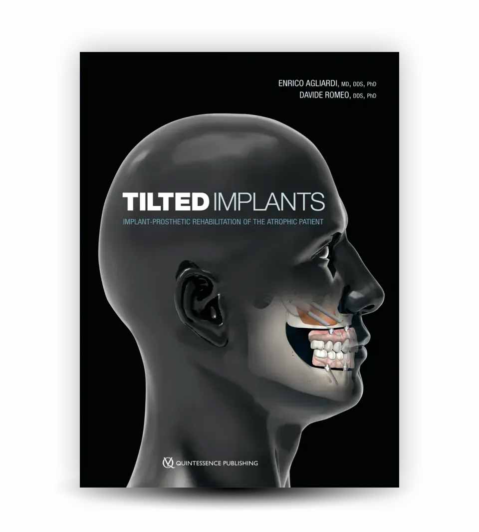 tilted implants implant prosthetic rehabilitation of the atrophic patient