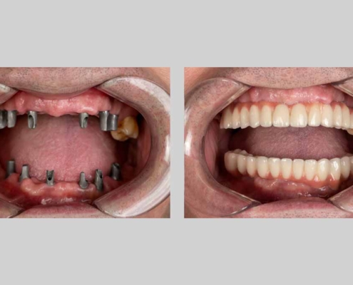 All-on-4 vs. Conventional Implant Prosthesis: What’s the Difference?