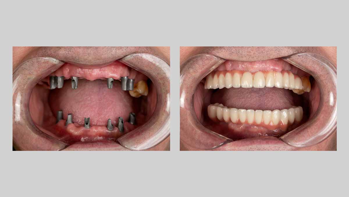 All-on-4 vs. Conventional Implant Prosthesis: What’s the Difference?