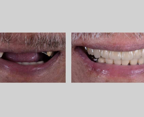 How to Care for Your Immediate All-on-4 Prosthesis