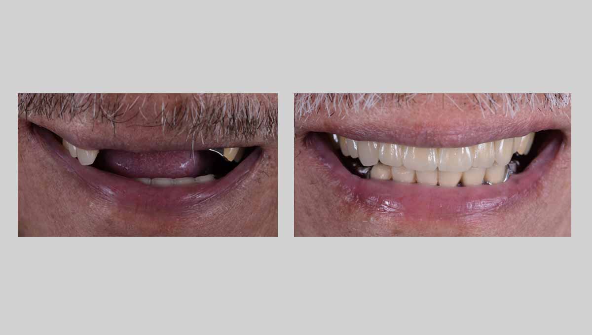 How to Care for Your Immediate All-on-4 Prosthesis