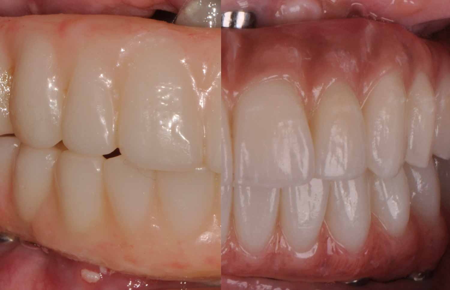 all-on-4 before & after