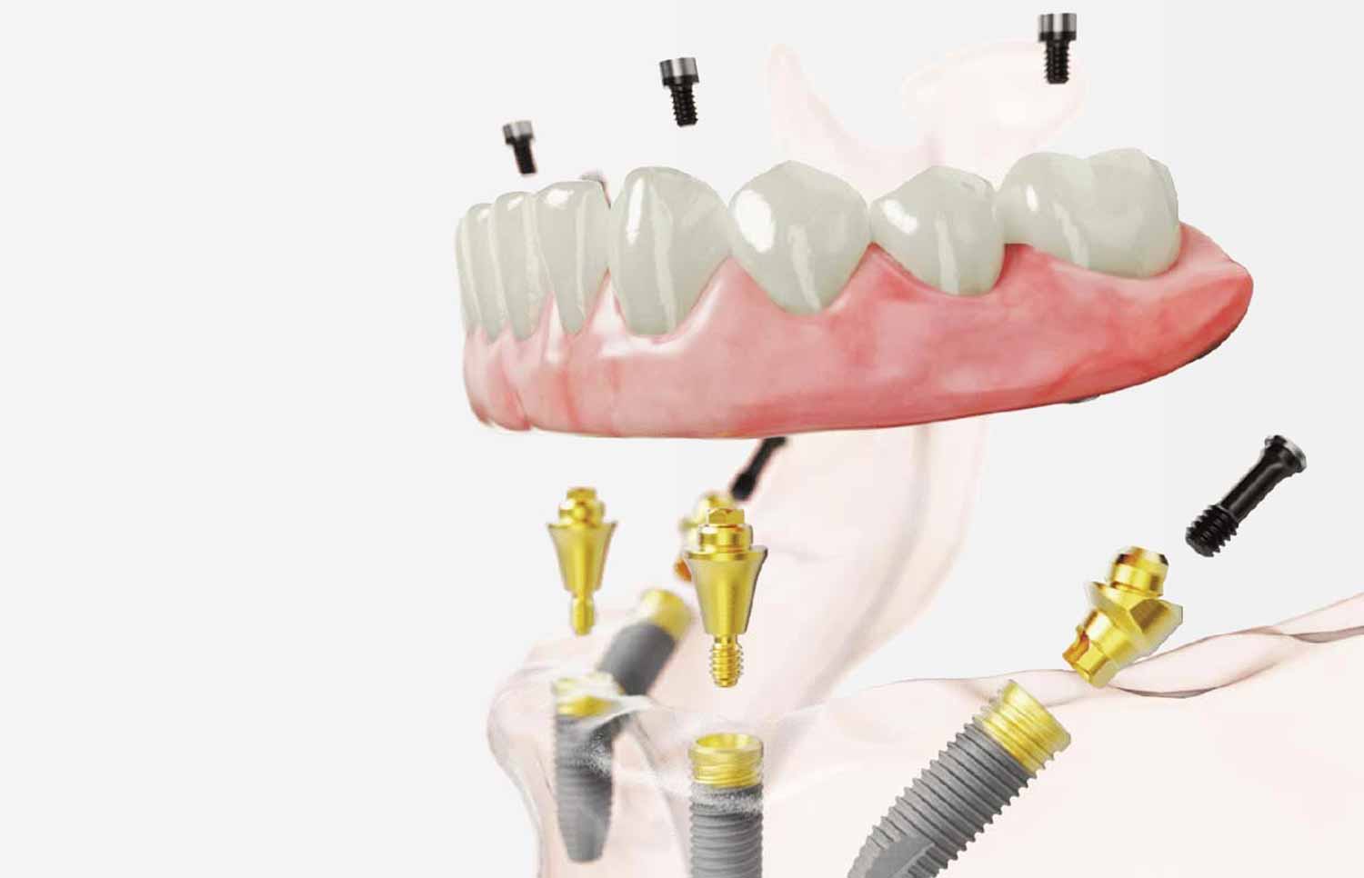 all-on-4 prosthesis