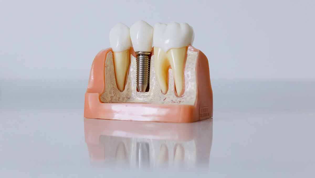 Dental Implant Cost in NYC How Much Do Dental Implants Really Cost